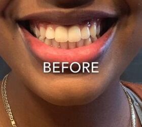 baking soda on teeth whitening