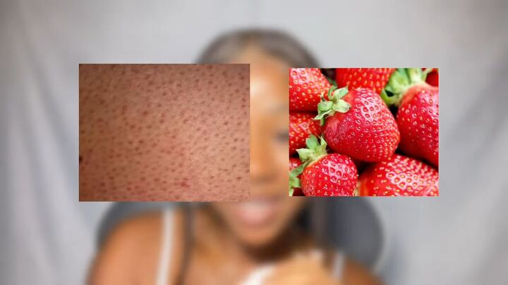 how to get rid of strawberry legs quick and easily, Strawberry legs