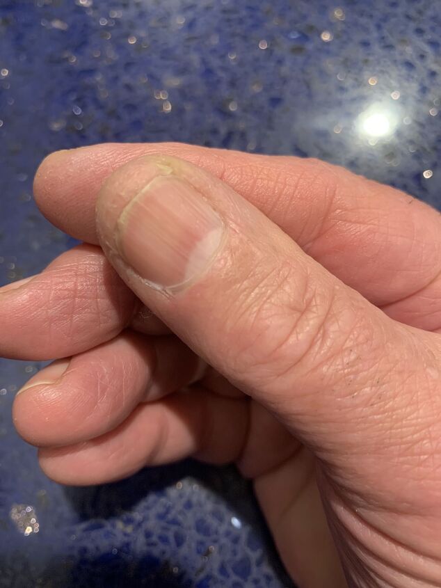 A Simple Inexpensive Winter Treatment for Dry, Cracked Fingertips ...