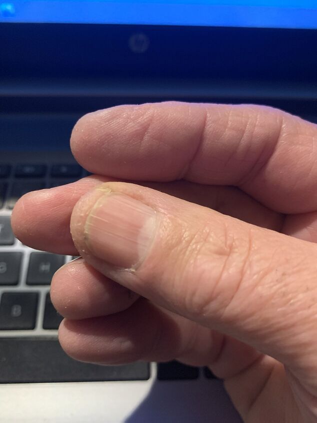 A Simple Inexpensive Winter Treatment for Dry, Cracked Fingertips ...