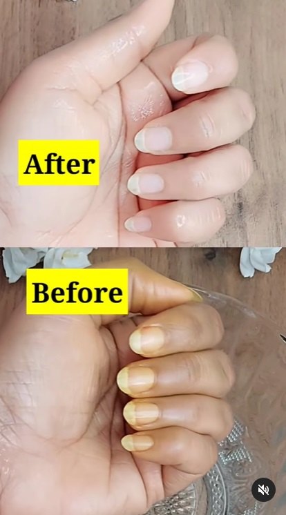 do this to turn your yellow nails white, Before and after