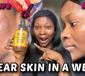 5 Methods to Get Rid of Acne & Skin Problems With Apple Cider Vinegar