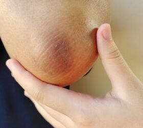 Why women are wiping glycolic acid on their elbows