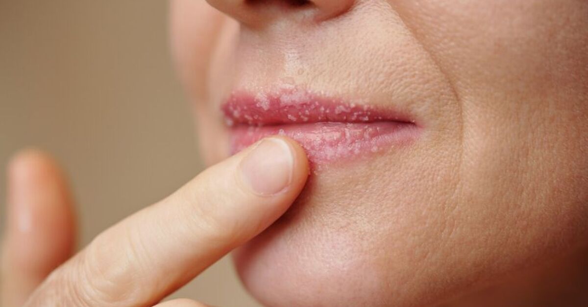 Lip Chapping How to Get Rid of Extremely Dry and Chapped Lips | Upstyle