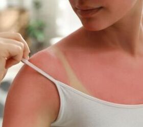 diy aftersun spray, Sunburn image via Canva